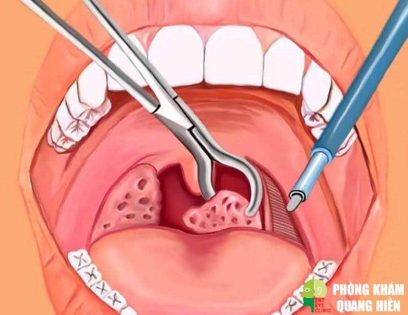 Cách trị dứt điểm viêm amidan