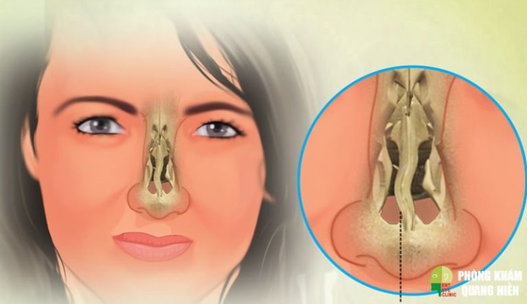 Sưng vách ngăn mũi, và 4 biến chứng nguy hiểm bạn nên biết